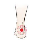 Orthotics for Achilles Tendonitis