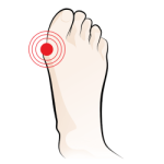 Orthotics for Bunions