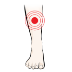 Orthotics for Shin Splints